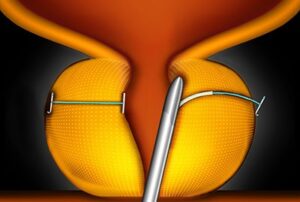 The UroLift Procedure