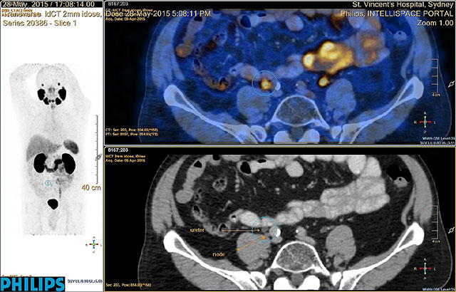 Focal HIFU