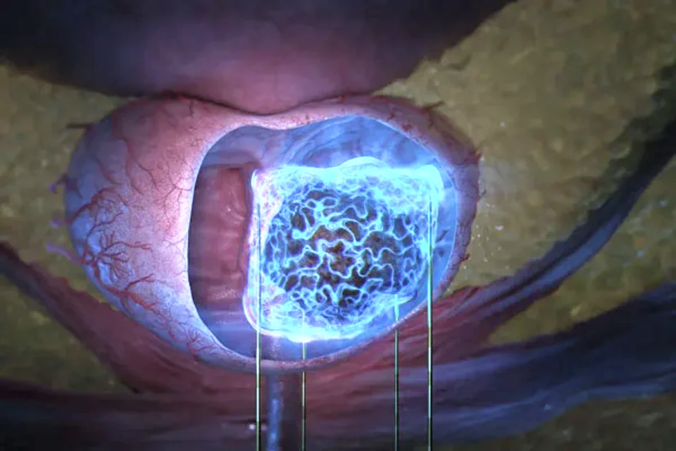 Nanoknife IRE Probes